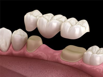 Dental bridge