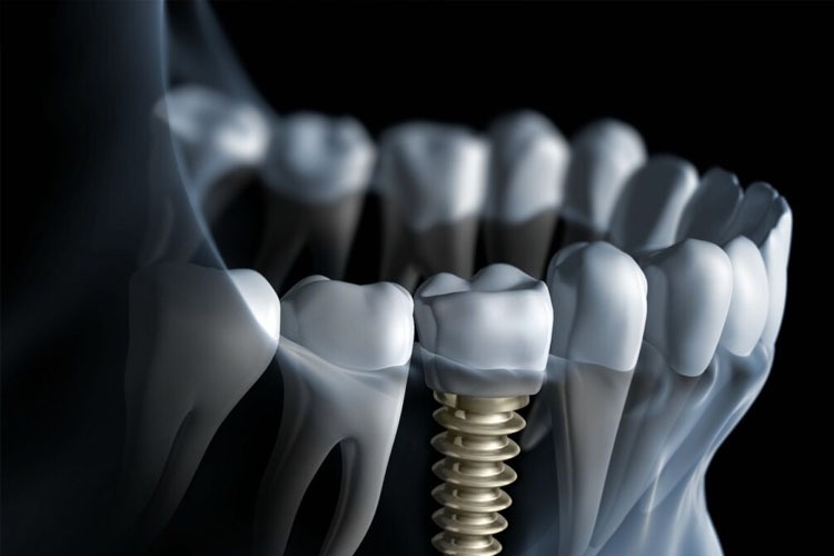dental implants in Ipswich