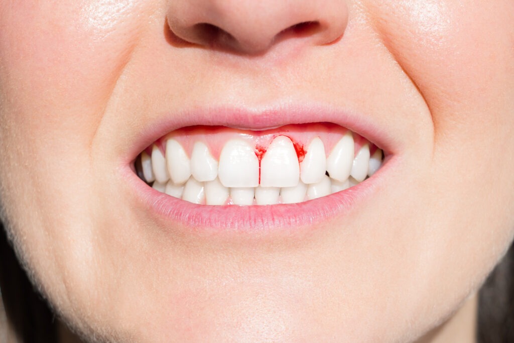 Why Do My Gums Bleed When I Brush My Teeth? - Quest Dental Care